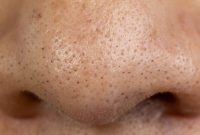 DIY Blackhead Solutions for Flawless Summer Skin