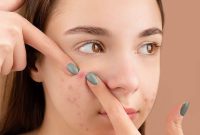 Soothe and Heal: Natural Ways to Calm Post-Pimple Redness and Swelling