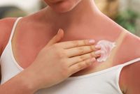 Sunburn Savior: 5 Natural Remedies for Instant Pain Relief and Peel-Free Skin