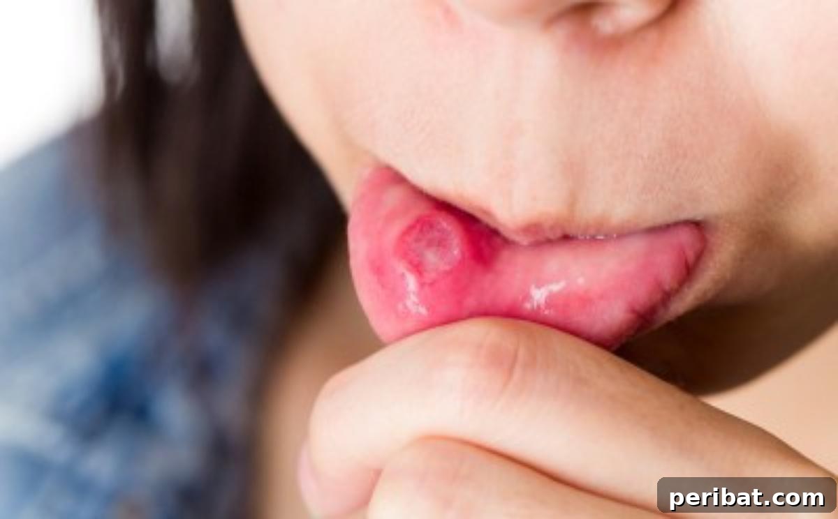 51 Genius Hydrogen Peroxide Hacks 5 Canker sores in mouth