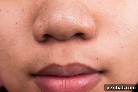 Epsom salt solution for dislodging stubborn blackheads