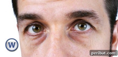 32 Astonishing Secrets of Witch Hazel for Beauty Health Home and Pet Care 10 Get rid of bags under your eyes.