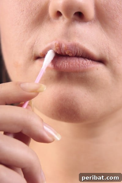 32 Astonishing Secrets of Witch Hazel for Beauty Health Home and Pet Care 17 Heal a cold sore.