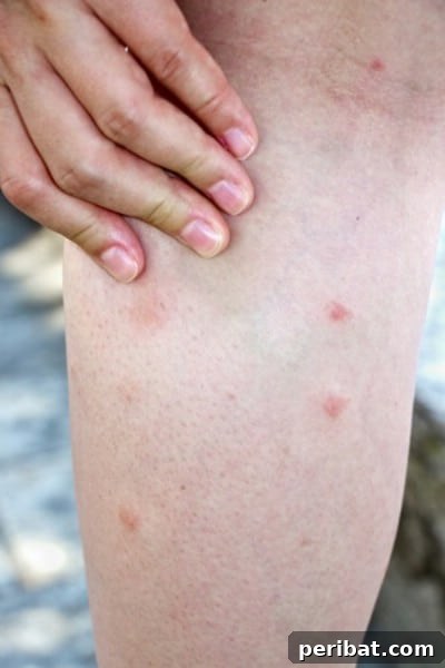 32 Astonishing Secrets of Witch Hazel for Beauty Health Home and Pet Care 20 Heal bug bites.