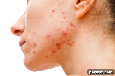 32 Astonishing Secrets of Witch Hazel for Beauty Health Home and Pet Care 5 Treat acne.