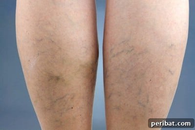 32 Astonishing Secrets of Witch Hazel for Beauty Health Home and Pet Care 9 Shrink varicose veins.