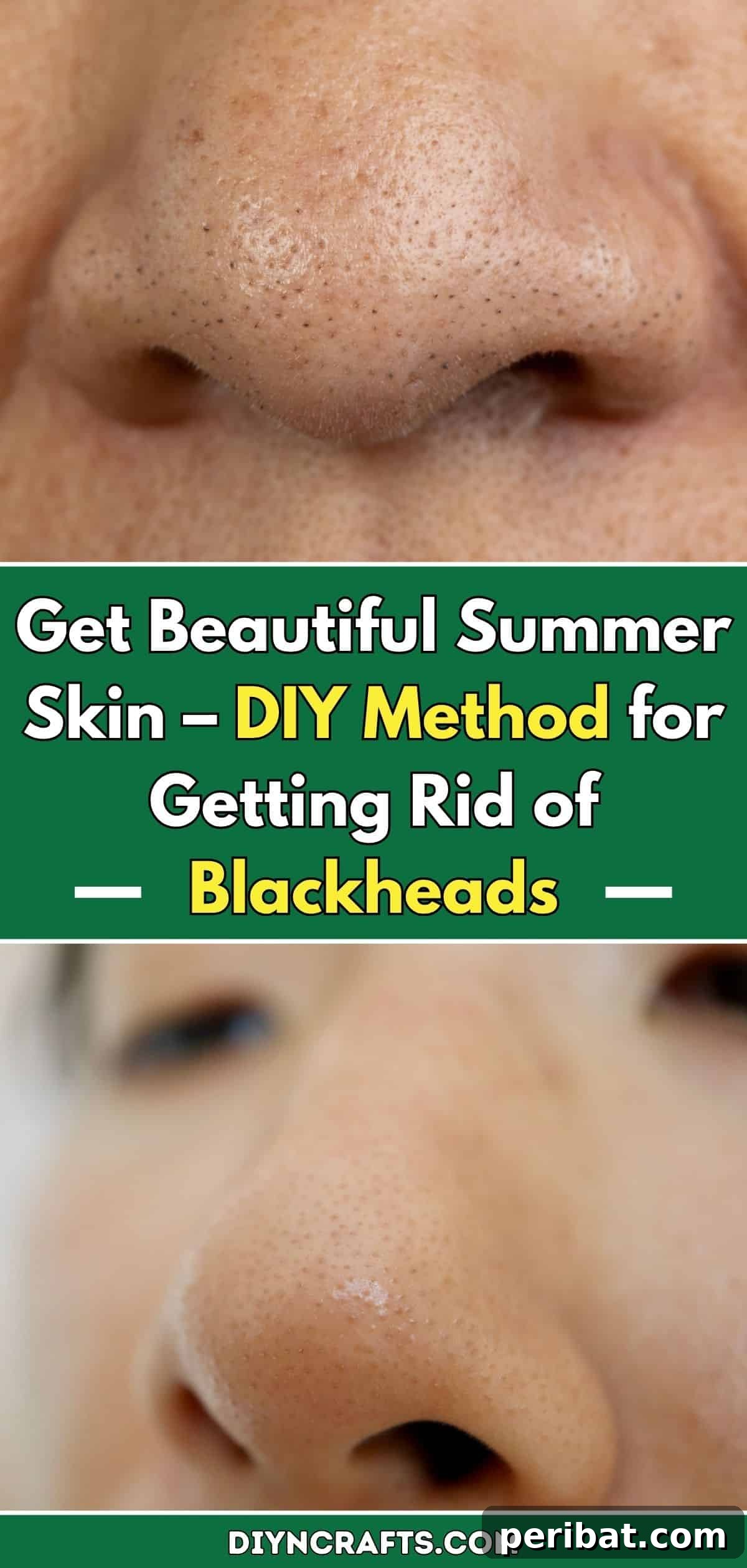 Get Beautiful Summer Skin – DIY Method for Getting Rid of Blackheads pinterest image