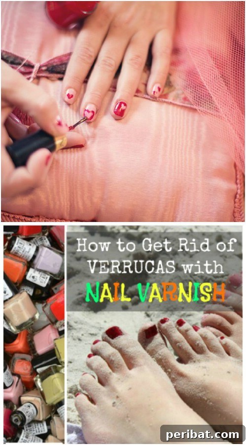 24 Clear Nail Polish Life Hacks You Need to Know 11 Wart Removal