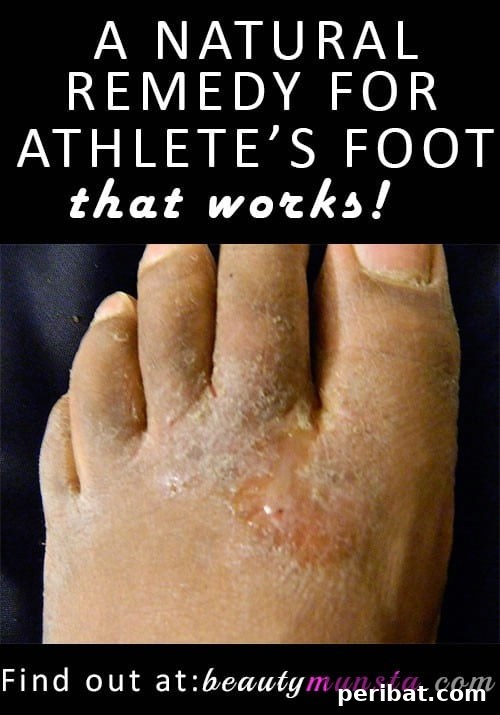 Natural Athlete’s Foot Remedy featuring Cornstarch
