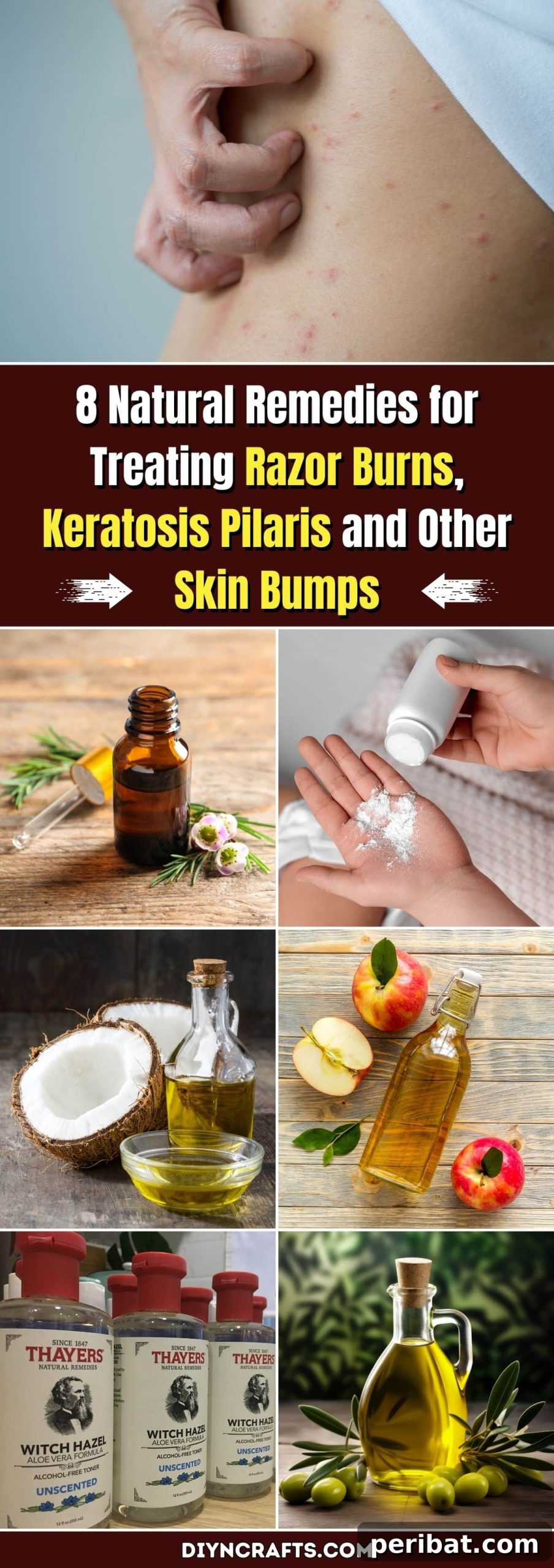 8 Natural Ways to Soothe Razor Bumps, KP, and Other Skin Imperfections 2 8 Natural Remedies for Treating Razor Burns, Keratosis Pilaris and Other Skin Bumps pinterest image
