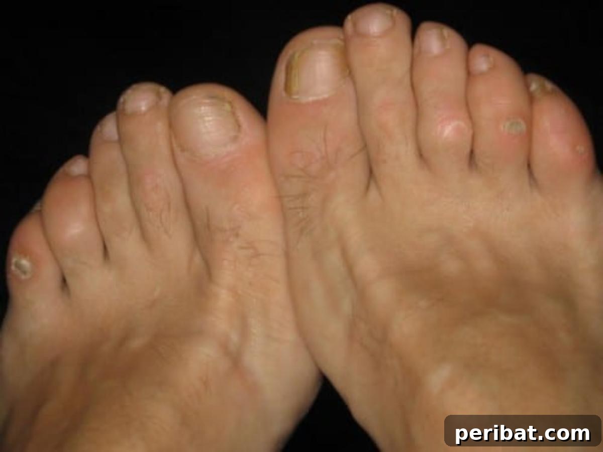 Feet showing calluses and corns, highlighting topical treatment with castor oil