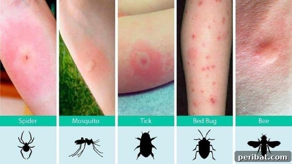Essential Summer Hacks for a Stress-Free Season 4 Bug bite infographic